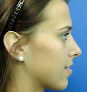 Side view of patient's face after rhinoplasty