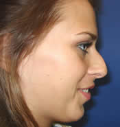 Side view of patient's face before rhinoplasty