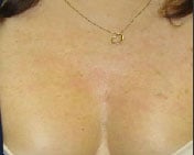 Patient's chest after laser skin resurfacing