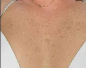 Patient's chest before laser skin resurfacing