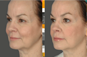 Patient's face before and after Ultherapy