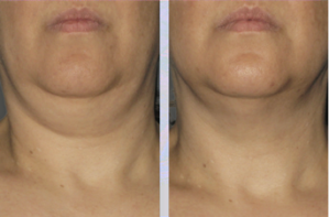 Neck view of patient's face before and after Ultherapy