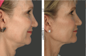 Side view of patient's face before and after Ultherapy